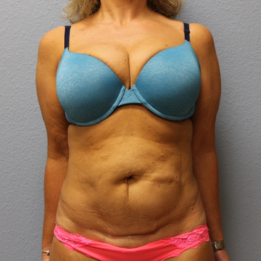 Tummy Tuck Patient Before 3