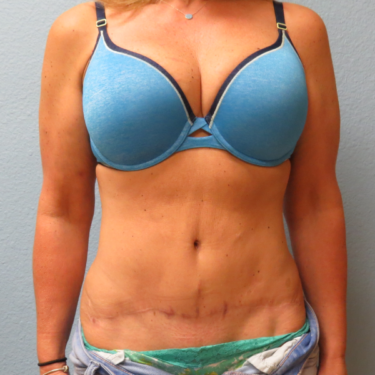 Tummy Tuck Patient After 4