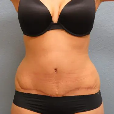 Tummy Tuck Patient After 2