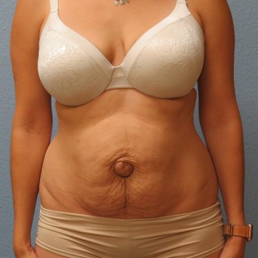 Tummy Tuck Patient Before 1