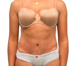 Tummy Tuck Patient After 6