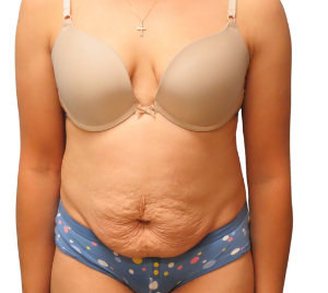 Tummy Tuck Patient Before 5